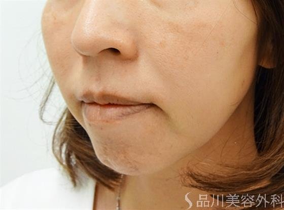症例NO.36174のBEFORE写真