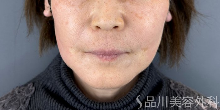 症例NO.72570のAFTER写真