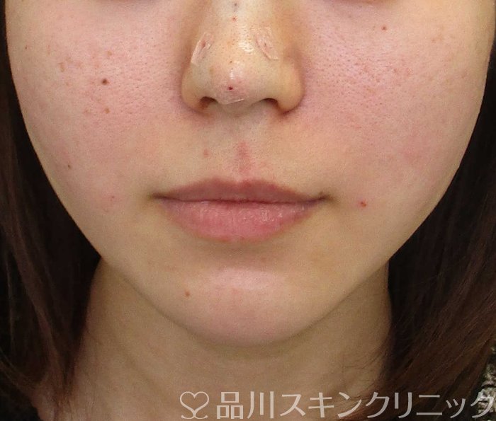 症例NO.65066のAFTER写真