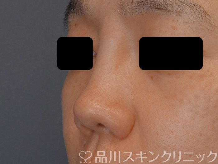 症例NO.72366のBEFORE写真