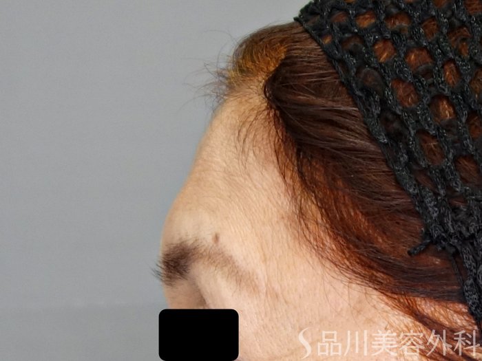 症例NO.70146のBEFORE写真