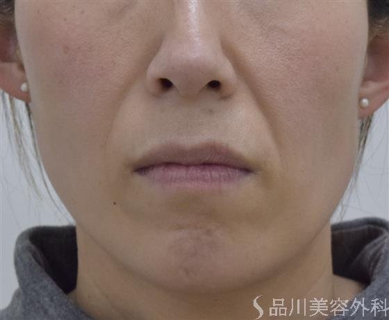 症例NO.51898のBEFORE写真