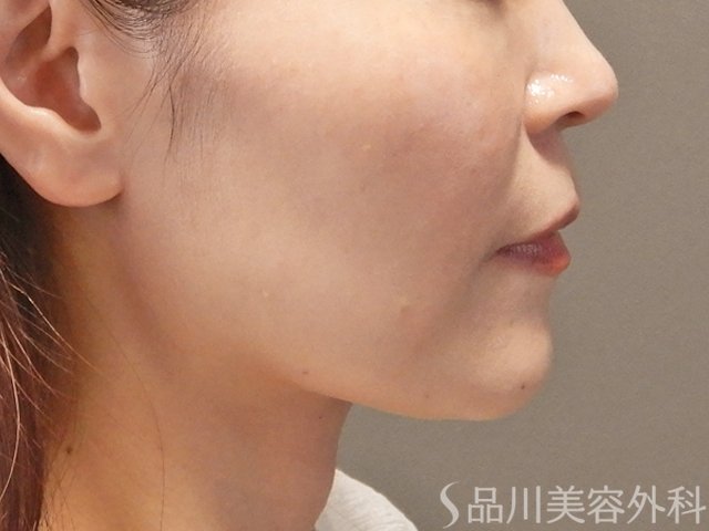 症例NO.74037のBEFORE写真