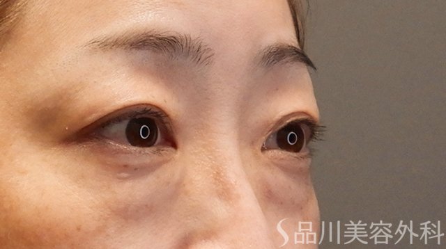 症例NO.75229のBEFORE写真