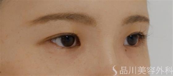 症例NO.36530のBEFORE写真