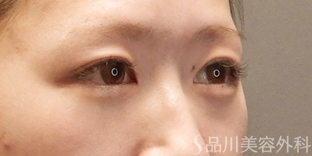 症例NO.74060のAFTER写真
