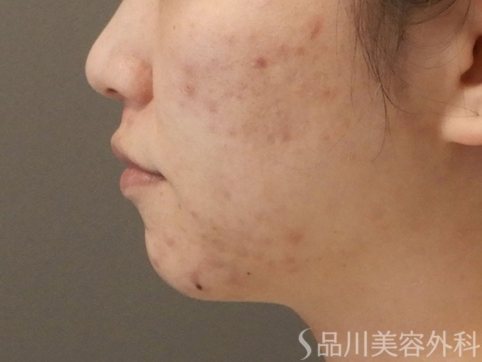 症例NO.71675のBEFORE写真