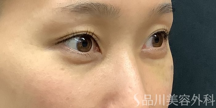 症例NO.71239のBEFORE写真