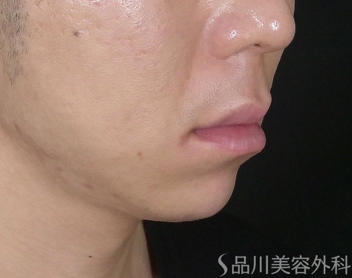 症例NO.67602のAFTER写真