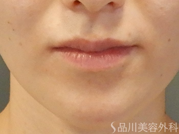 症例NO.65445のBEFORE写真