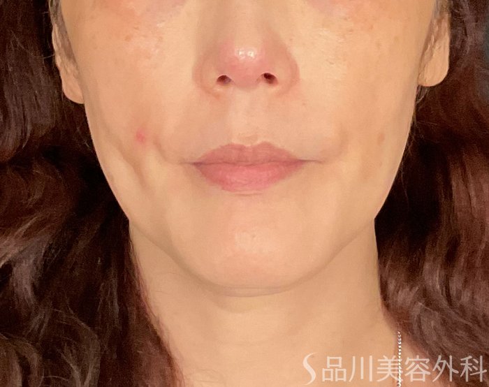 症例NO.74748のBEFORE写真