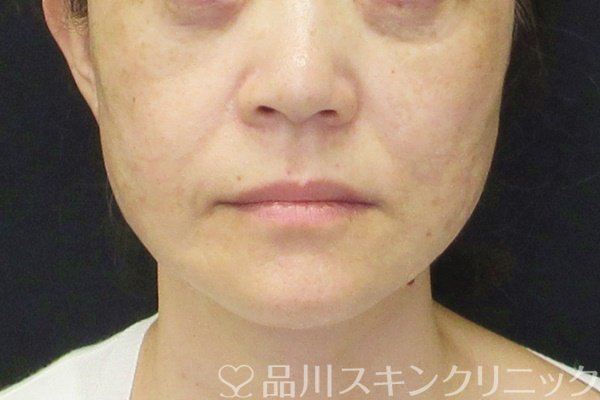 症例NO.65402のAFTER写真