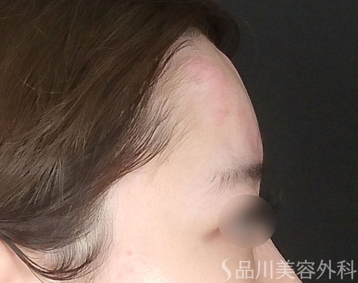 症例NO.70172のAFTER写真
