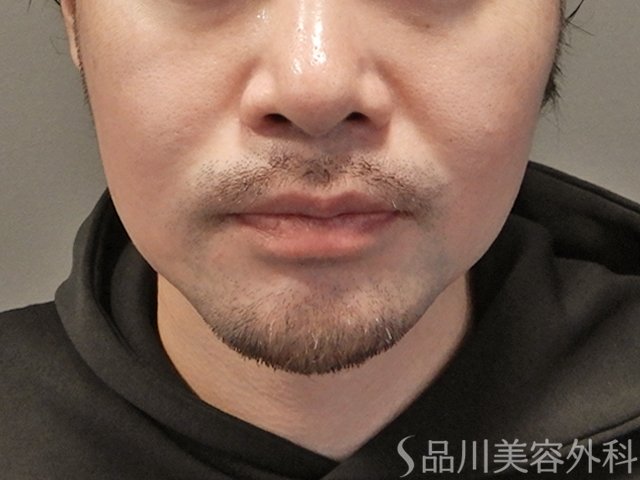 症例NO.74957のBEFORE写真