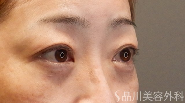 症例NO.75229のAFTER写真