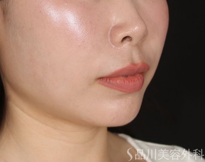 症例NO.73315のAFTER写真