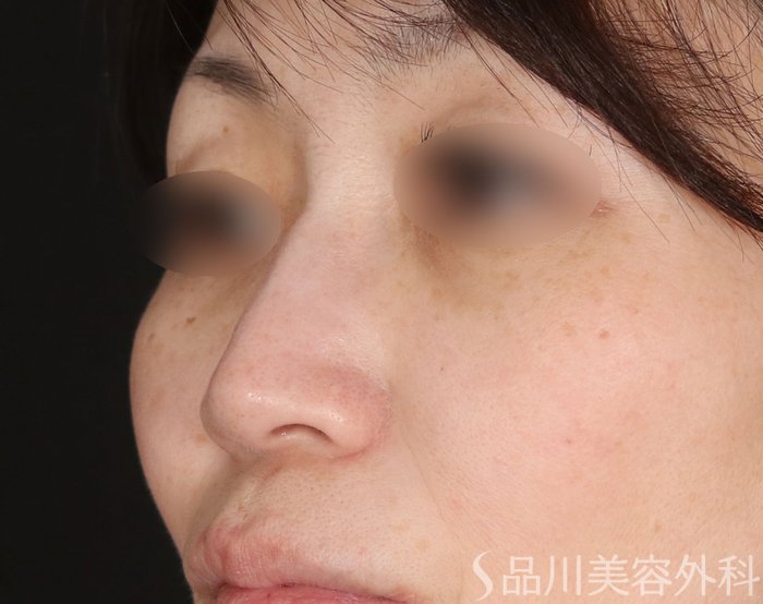 症例NO.73675のBEFORE写真