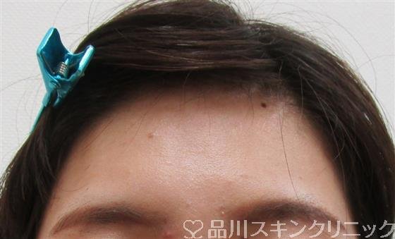 症例NO.32055のBEFORE写真