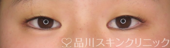 症例NO.65859のBEFORE写真