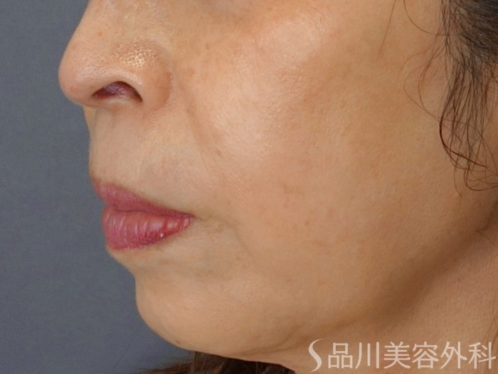 症例NO.74232のBEFORE写真