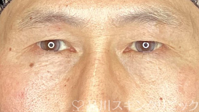 症例NO.71419のBEFORE写真