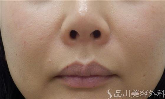 症例NO.38655のBEFORE写真