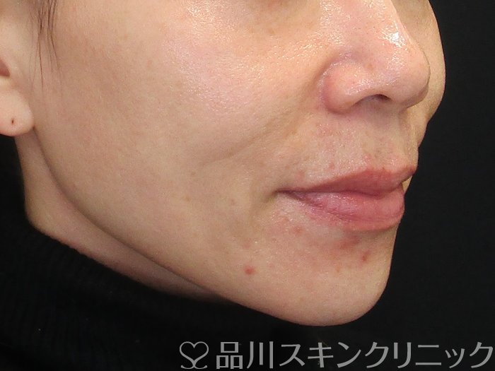 症例NO.72854のBEFORE写真