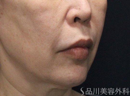 症例NO.74958のBEFORE写真