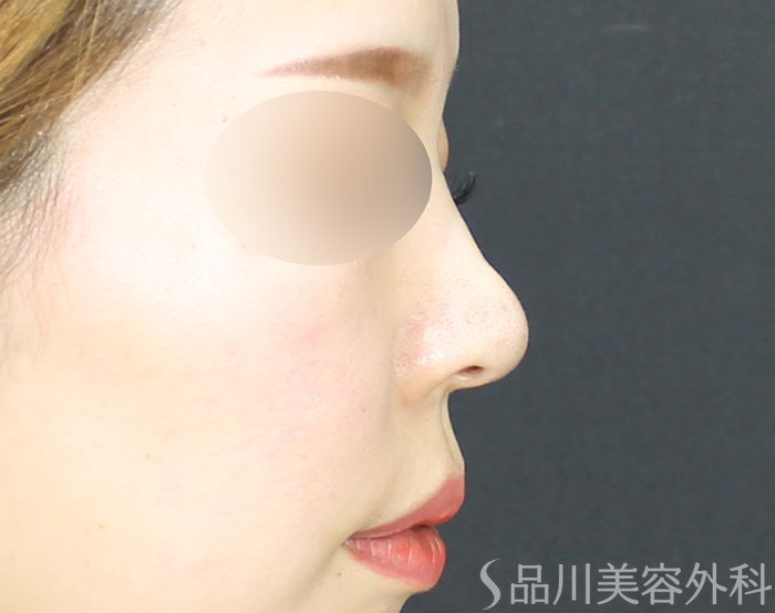 症例NO.71791のAFTER写真