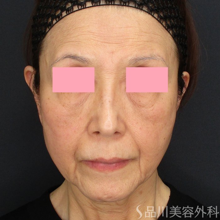 症例NO.73897のBEFORE写真