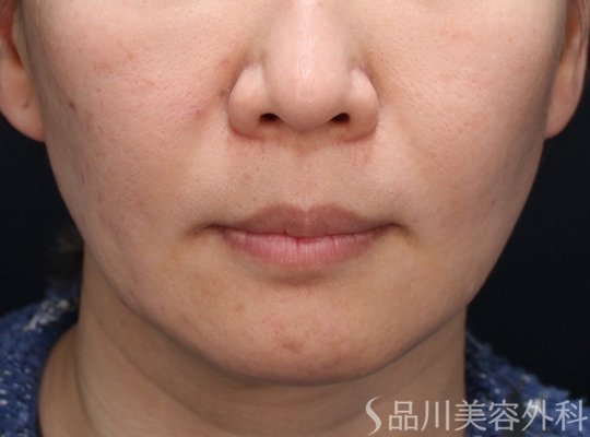 症例NO.73333のBEFORE写真