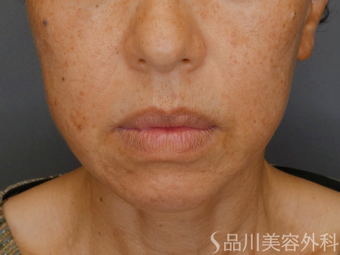 症例NO.71573のBEFORE写真