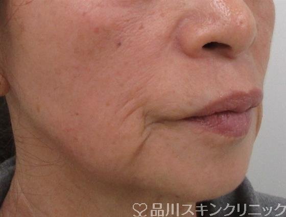 症例NO.40314のBEFORE写真
