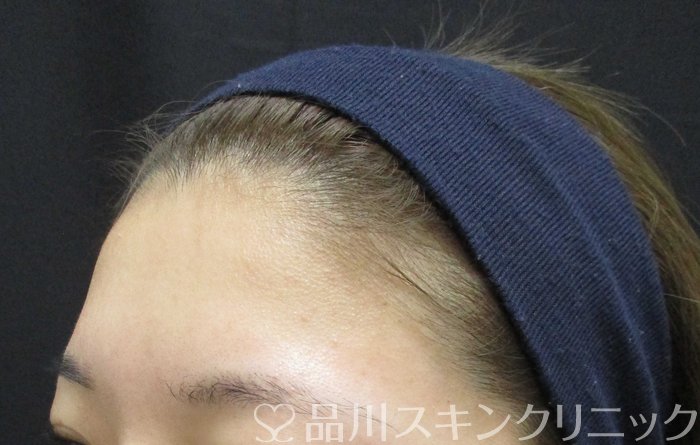 症例NO.65015のBEFORE写真
