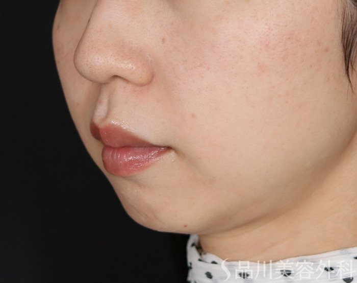 症例NO.71885のBEFORE写真