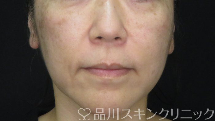 症例NO.71922のBEFORE写真