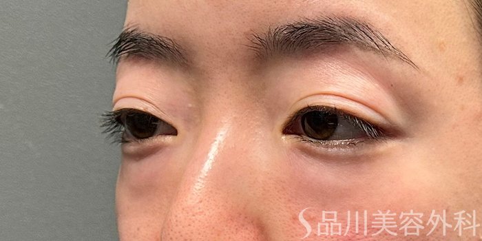 症例NO.72838のBEFORE写真