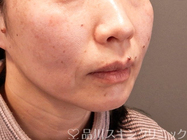症例NO.70489のBEFORE写真