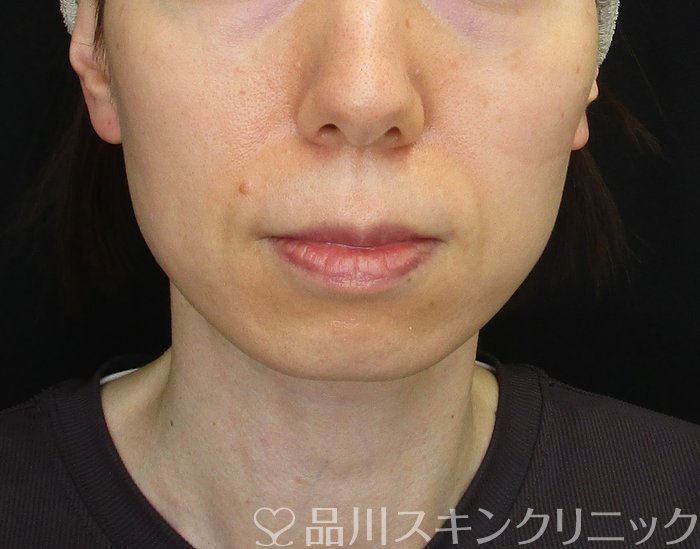 症例NO.74728のBEFORE写真