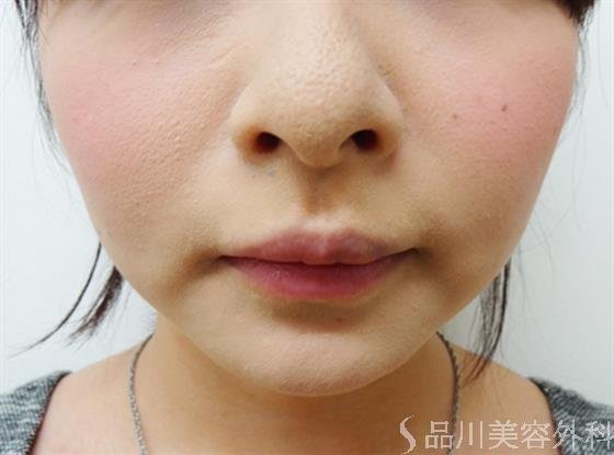 症例NO.24993のAFTER写真