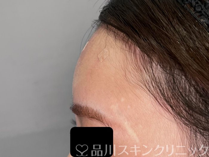 症例NO.70001のAFTER写真