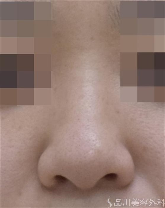 症例NO.50692のBEFORE写真
