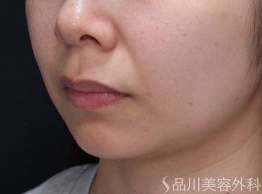 症例NO.73035のBEFORE写真