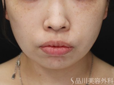 症例NO.73724のAFTER写真