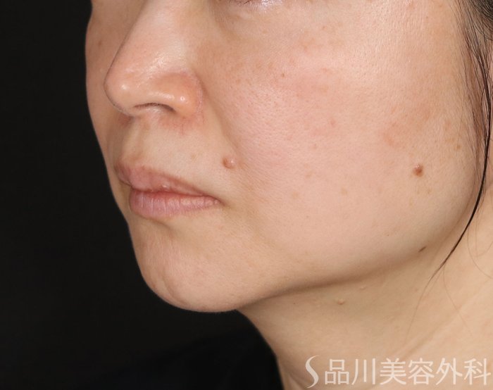 症例NO.73280のBEFORE写真