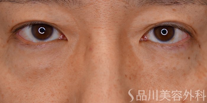 症例NO.65692のBEFORE写真