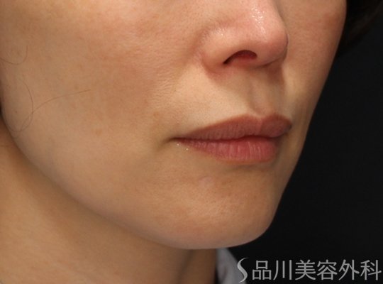 症例NO.73348のBEFORE写真