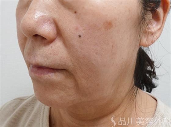 症例NO.53641のBEFORE写真