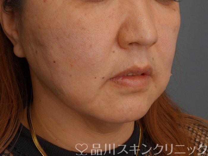 症例NO.75278のAFTER写真