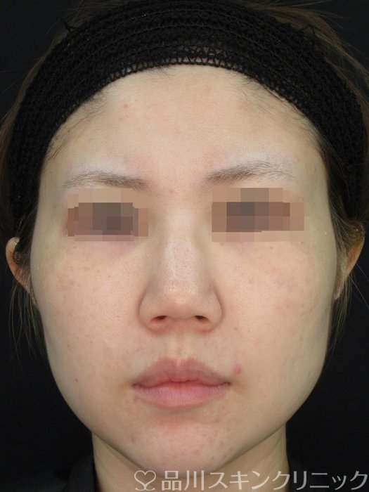 症例NO.72753のAFTER写真